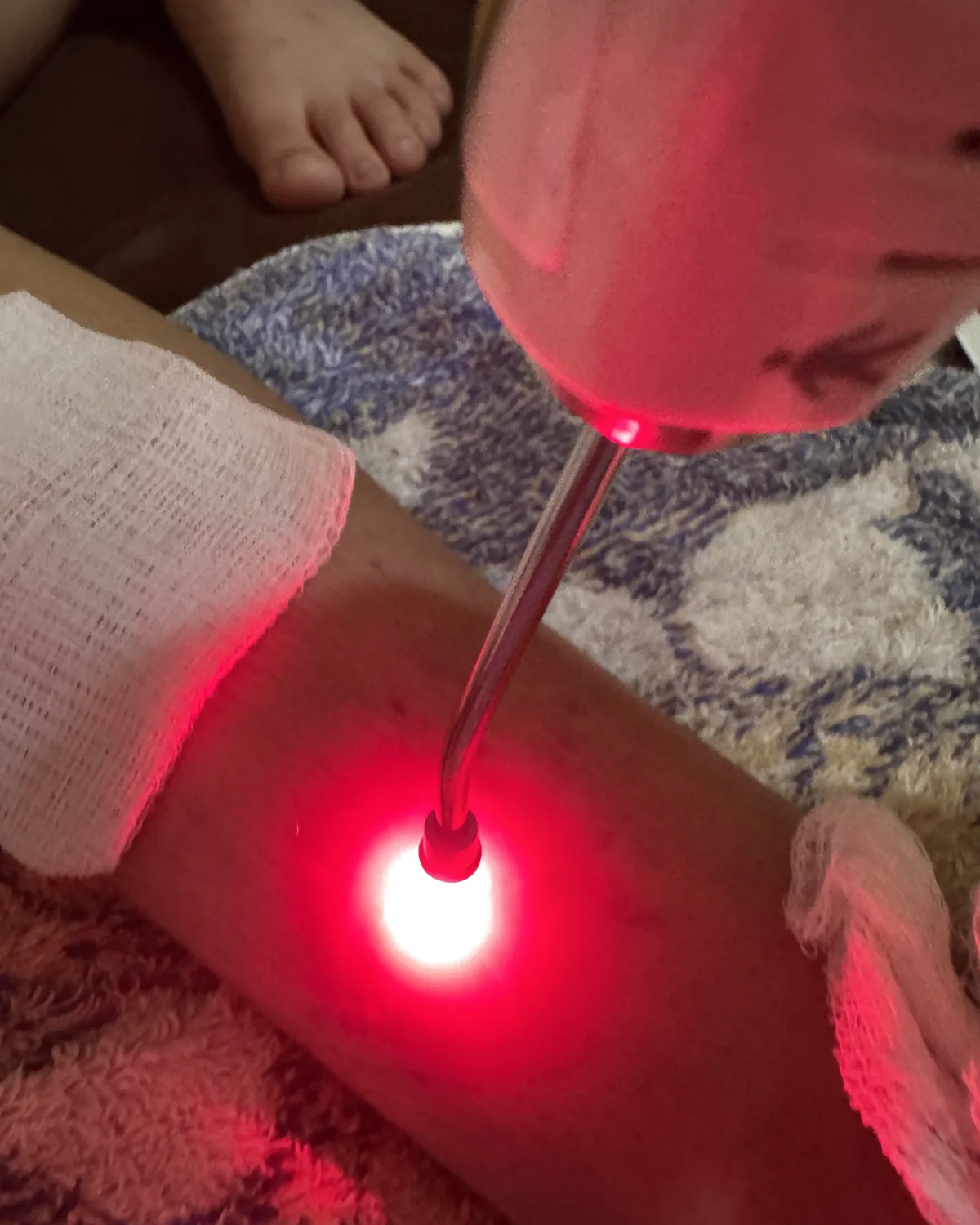 Feixe de laser vermelho aplicado sobre a pele durante sessão de fotobiomodulação