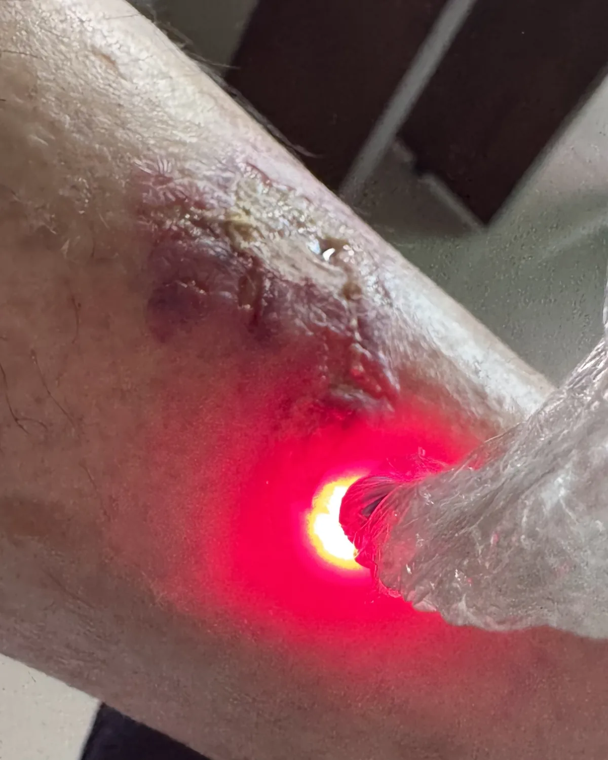Aplicação de laser em lesão na perna durante sessão de fotobiomodulação