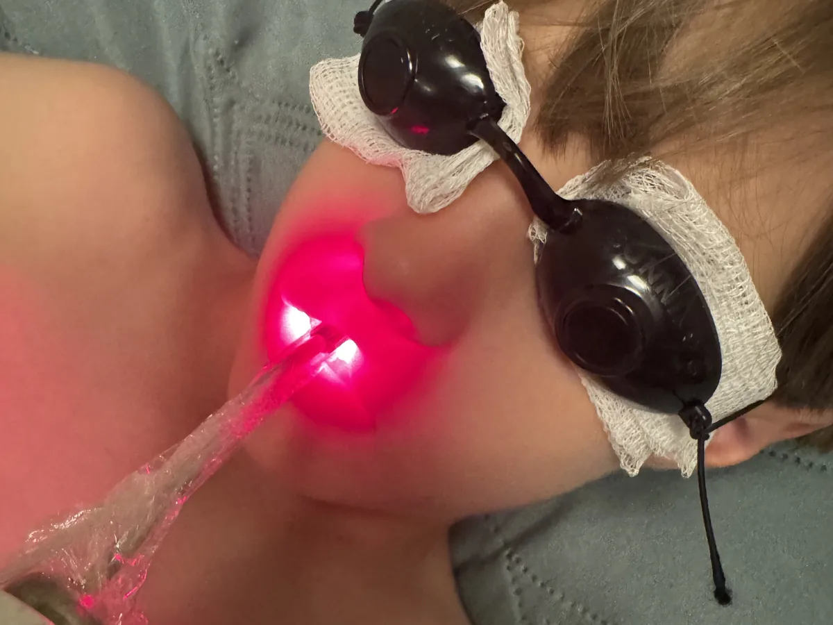 Bebê com óculos de proteção recebendo laserterapia no rosto